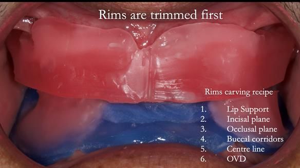 Finlay's Newsletter 62 provision of extractions and metal based complete dentures for Rafique