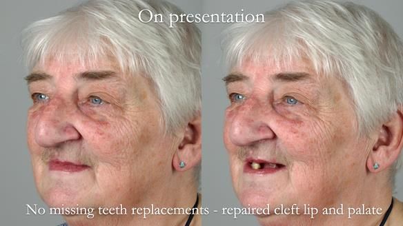 Newsletter 55 Provision of metal based partial dentures for Zephyrine with a repaired cleft lip and palate