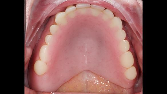 Newsletter 80 - Gordon’s dentures: the one case in 1,000 where my technique failed