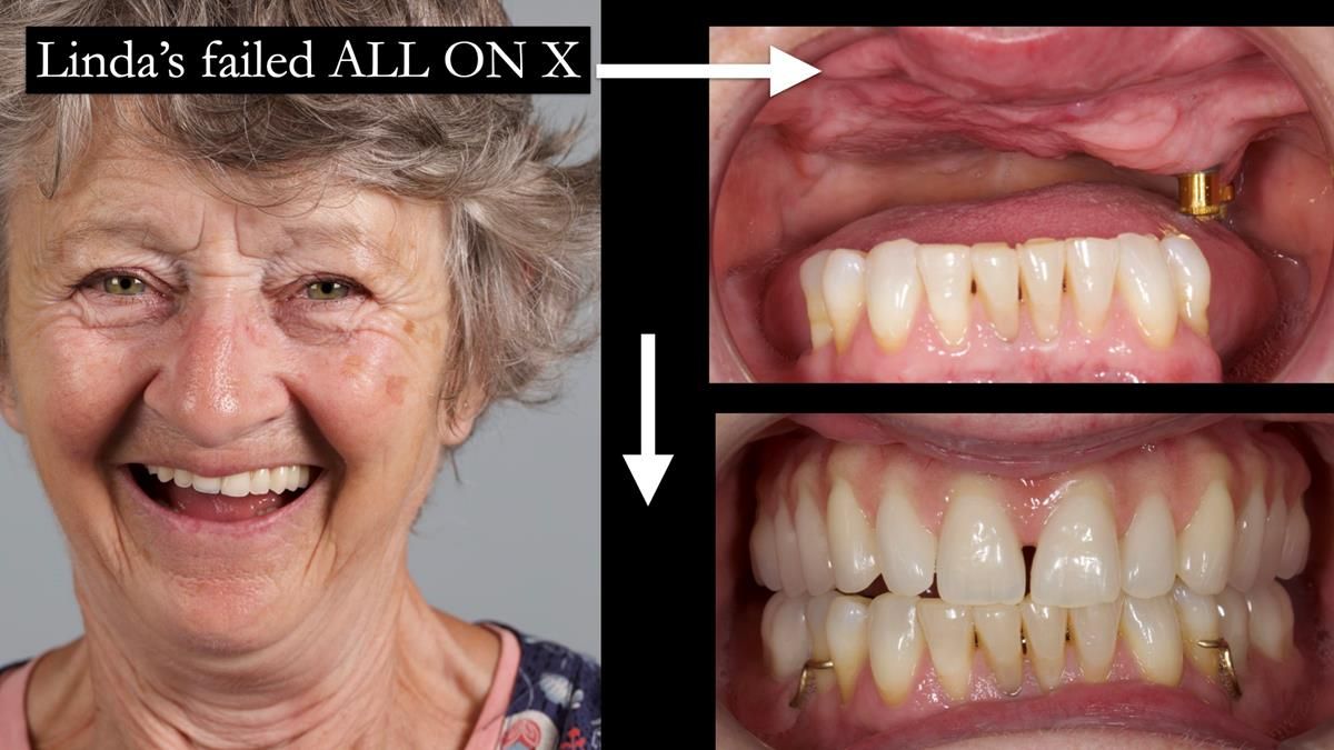 Newsletter 87 – Father Peter: A Partial Denture that needed Minor Miracle