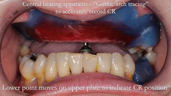 Finlay's Newsletter 58 Gasket upper partial denture for Zoe