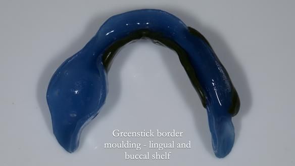 Newsletter 82 Mary - A complete upper and a one-tooth gasket denture