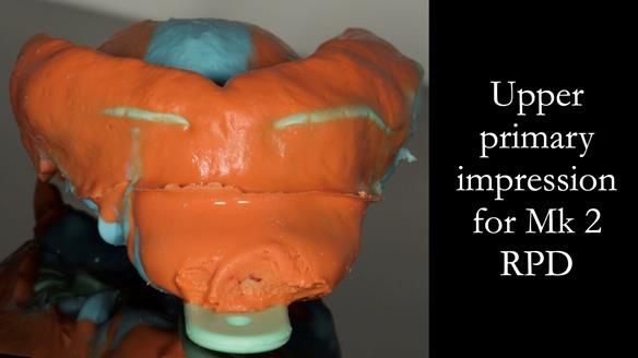 Finlay's Case Study Newsletter 40 - Immediate Mk 1 RPD to Definitive Mk 2 RPD - full protocol