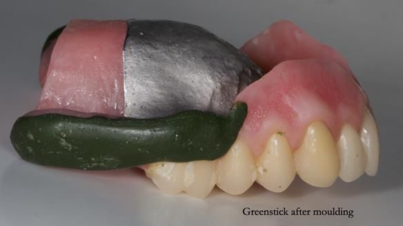 Newsletter 77: Jeremy’s case – immediate complete upper denture