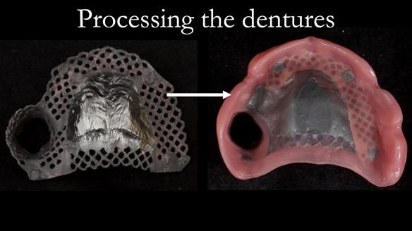 Finlay's Newsletter 58 Gasket upper partial denture for Zoe