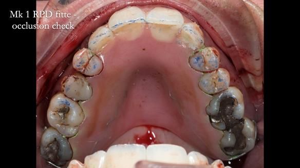 Finlay's Newsletter 63 Case study provision of metal based Scandinavian RPD - functional 10 years on