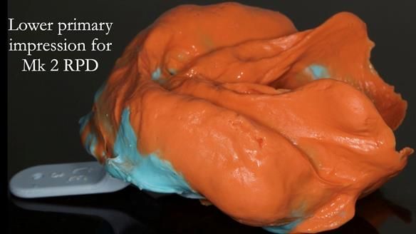 Finlay's Case Study Newsletter 40 - Immediate Mk 1 RPD to Definitive Mk 2 RPD - full protocol