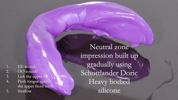 Replacing Madeline’s Complete denture FULL PROTOCOL