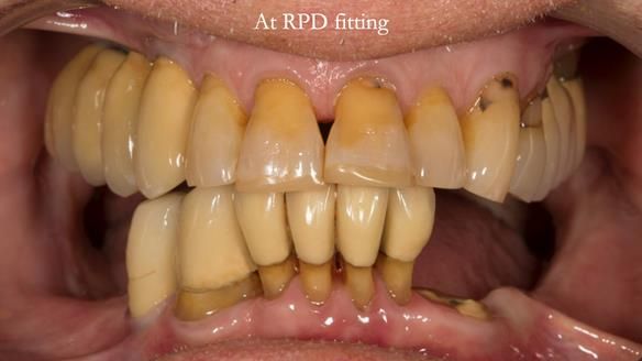 Ken – going downhill, first class