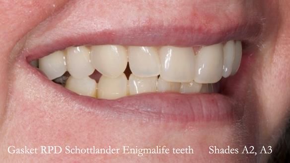 Finlay's Newsletter 58 Gasket upper partial denture for Zoe