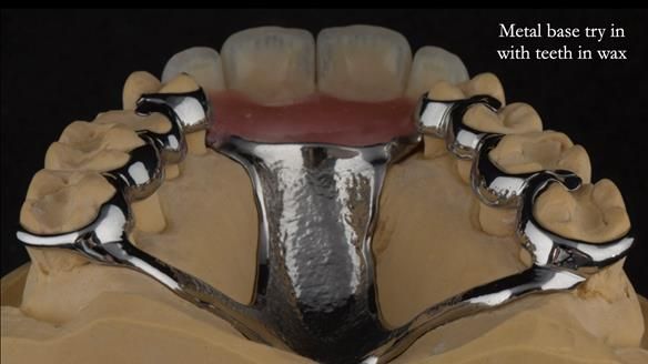 Finlay's Newsletter 63 Case study provision of metal based Scandinavian RPD - functional 10 years on