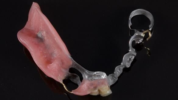 Newsletter 86 Peter the Architect — precision removable partial dentures case study