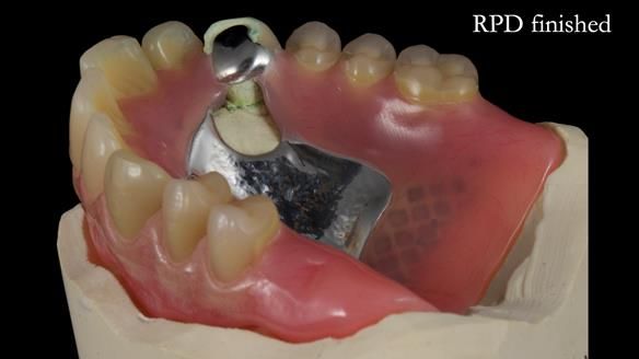 Newsletter 55 Provision of metal based partial dentures for Zephyrine with a repaired cleft lip and palate