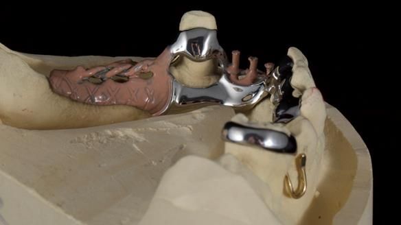 Newsletter 86 Peter the Architect — precision removable partial dentures case study
