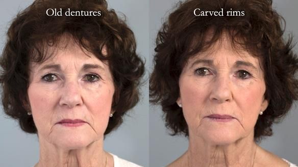 Newsletter 75: Marion’s case - Step-by-step complete denture workflow