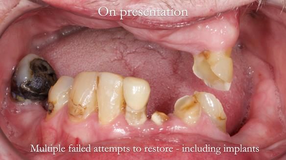 Newsletter 55 Provision of metal based partial dentures for Zephyrine with a repaired cleft lip and palate