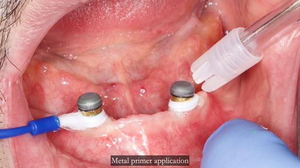 Newsletter 78: What do Clark Gable and a Locator® overdenture have in common?