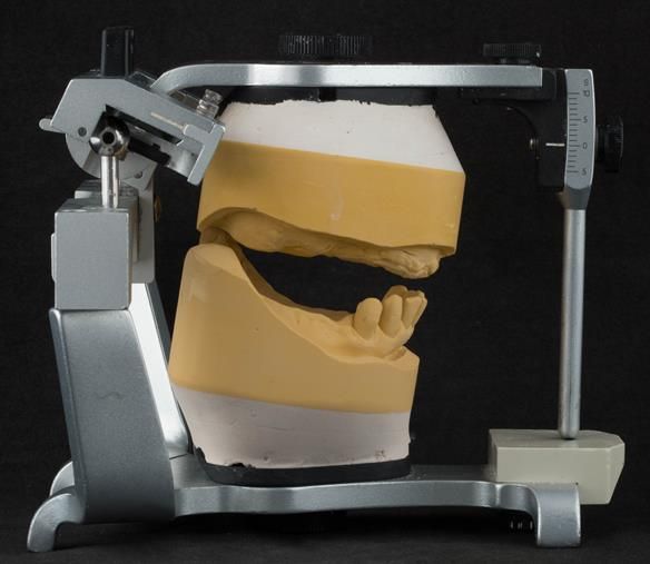 Figure 95 Mounted maxillary and mandibular definitive casts at desired OVD using the wax rim with facebow and in CR via the central bearing apparatus