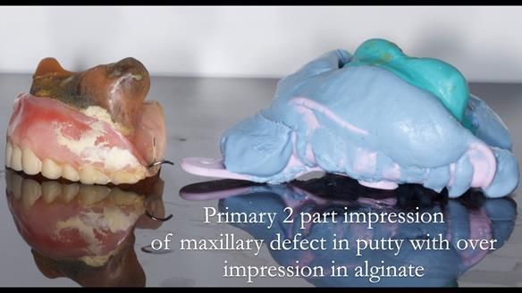 Upper metal base partial denture/occlusal stabilisation splint/obturator - full protocol