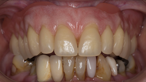 Figure 48 Immediate denture with chairside reline