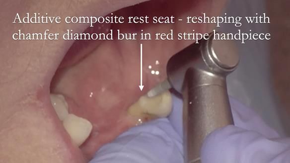 Finlay's Case Study Newsletter 40 - Immediate Mk 1 RPD to Definitive Mk 2 RPD - full protocol