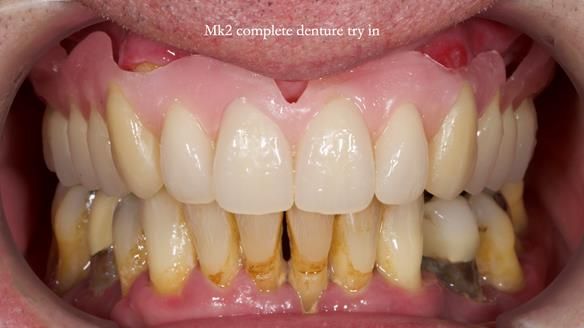Newsletter 77: Jeremy’s case – immediate complete upper denture