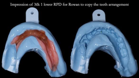 Newsletter 82 Mary - A complete upper and a one-tooth gasket denture