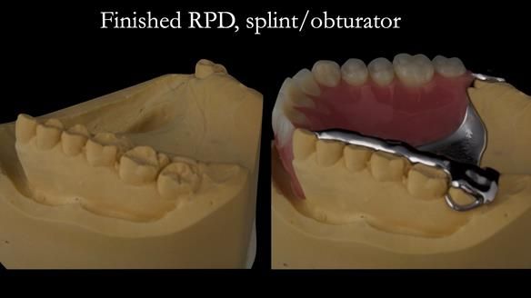 Upper metal base partial denture/occlusal stabilisation splint/obturator - full protocol