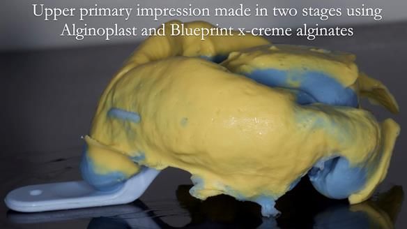 Newsletter 57 showcases the making and fitting process of implant-supported complete dentures for Alisdair