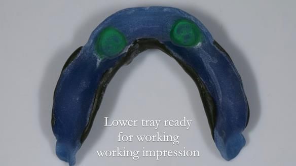 Newsletter 57 showcases the making and fitting process of implant-supported complete dentures for Alisdair