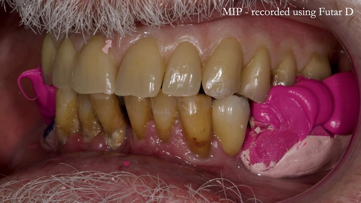 Newsletter 87 – Father Peter: A Partial Denture that needed Minor Miracle