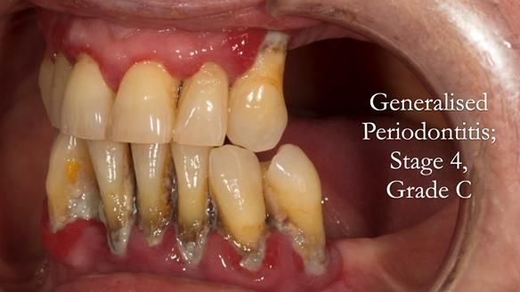 Finlay's Case Study Newsletter 40 - Immediate Mk 1 RPD to Definitive Mk 2 RPD - full protocol