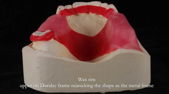 Finlay's Newsletter 60 Sylvia's upper Kennedy Class 2 Mod 1 metal based upper RPD