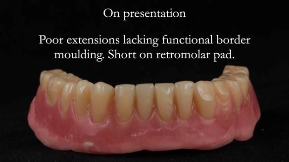 Finlay's Newsletter 62 provision of extractions and metal based complete dentures for Rafique