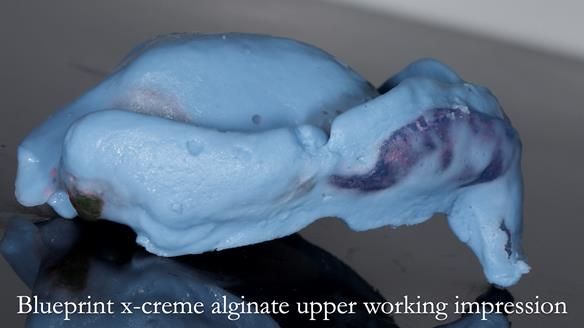 Newsletter 77: Jeremy’s case – immediate complete upper denture