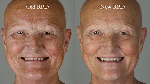 Newsletter 81 - Pam’s Story — how a partial denture changed her life (+ live walkthrough this Thursday)