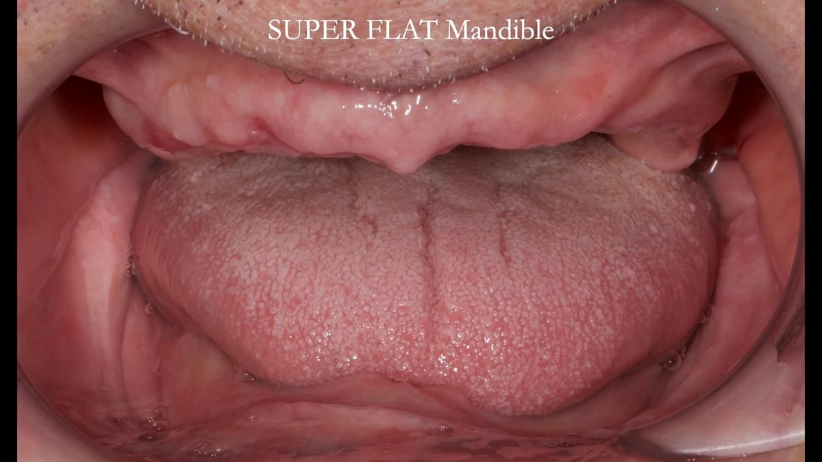 Fin’s Newsletter 88 — Complete dentures - full protocol… he rearranged his own teeth!
