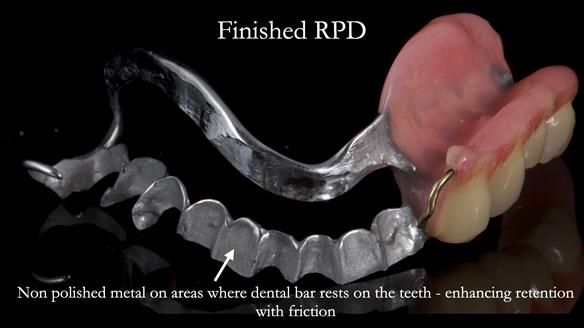 Finlay's Newsletter 61 provision of a lower unilateral free end saddle metal based partial denture for Joyce