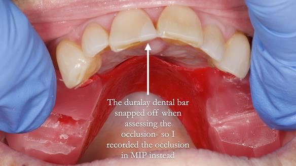 Finlay's Newsletter 60 Sylvia's upper Kennedy Class 2 Mod 1 metal based upper RPD