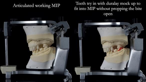 Finlay's Newsletter 61 provision of a lower unilateral free end saddle metal based partial denture for Joyce