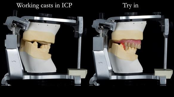 Newsletter 55 Provision of metal based partial dentures for Zephyrine with a repaired cleft lip and palate