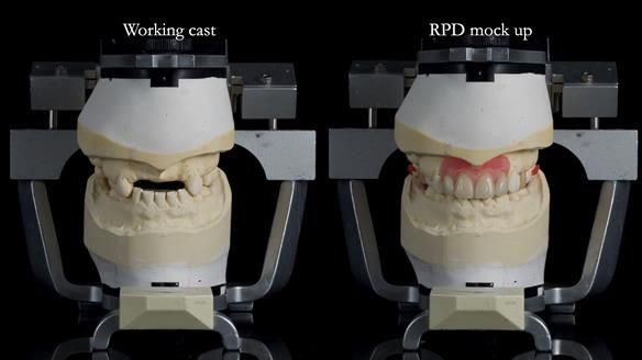 Newsletter 81 - Pam’s Story — how a partial denture changed her life (+ live walkthrough this Thursday)