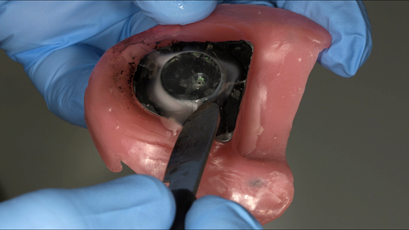 Figure 82 A plastic countersink hole is placed and fitted over the apex.