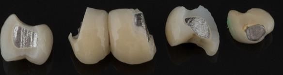 Figure 30 Sectioned bridge pontics.