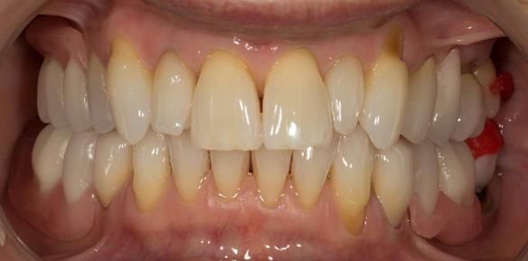 Figure 66 Teeth try in on pattern resin bases in the mouth. These help to confirm the accuracy of the working casts and the amount of metal work which will be visible in the final dentures