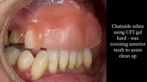 Finlay's Newsletter 63 Case study provision of metal based Scandinavian RPD - functional 10 years on