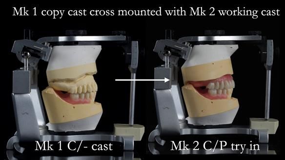 Newsletter 52 Managing Jo’s failing dentition with extractions and Mk 1/Mk 2 complete upper dentures and lower partial dentures FULL PROTOCOL