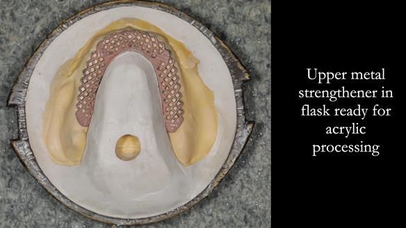 Newsletter 53 showing the making and fitting of ultra life-like dentures for Valena