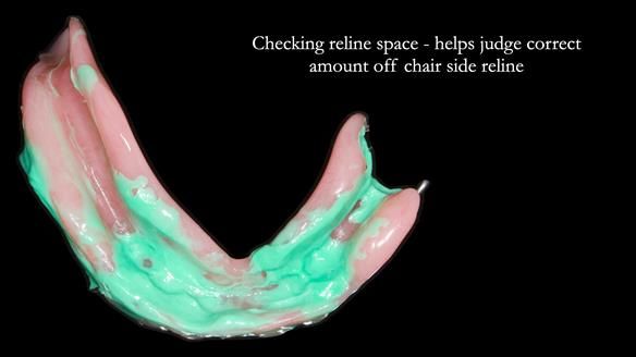 Newsletter 82 Mary - A complete upper and a one-tooth gasket denture