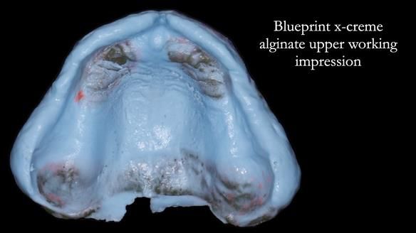 Newsletter 78: What do Clark Gable and a Locator® overdenture have in common?